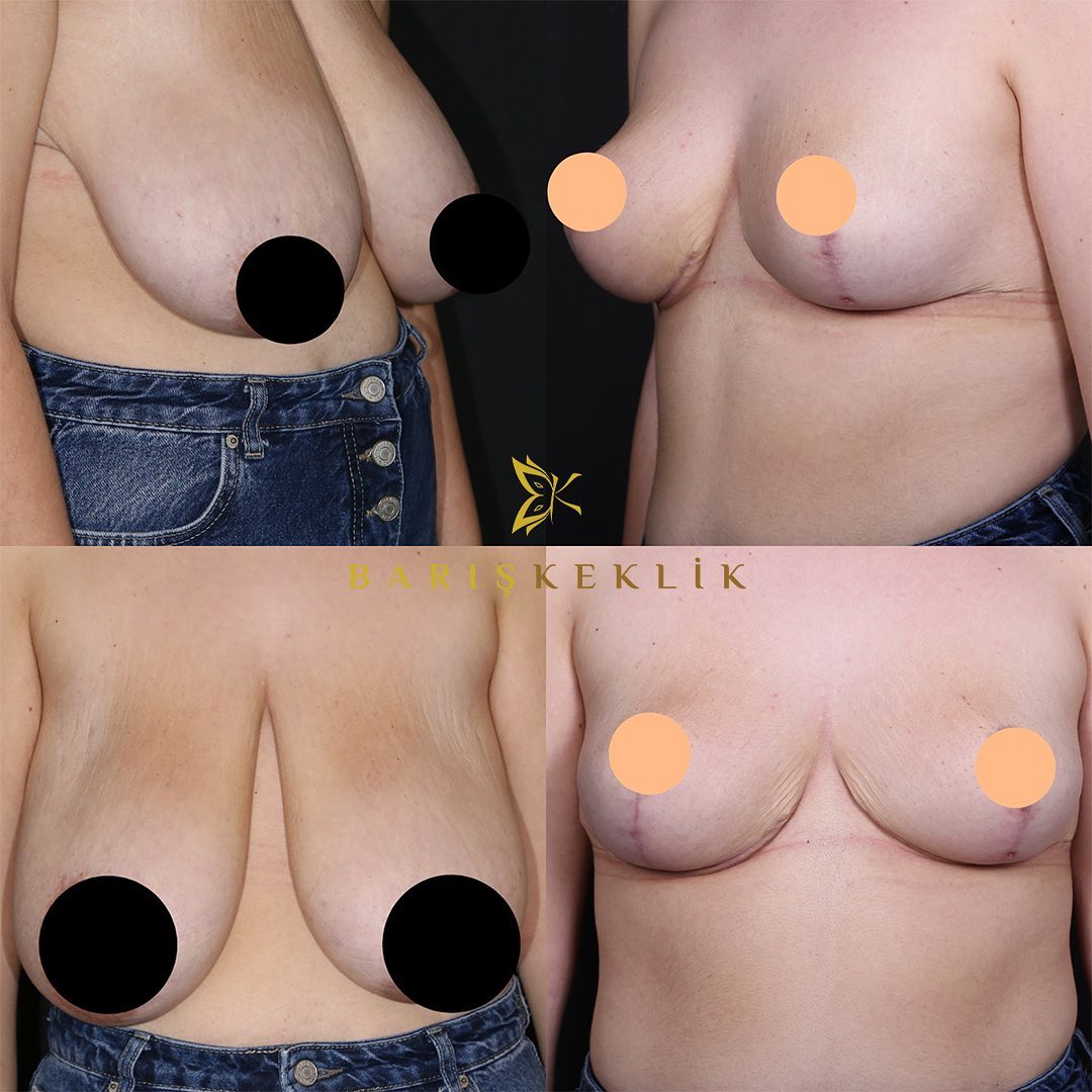 before-after