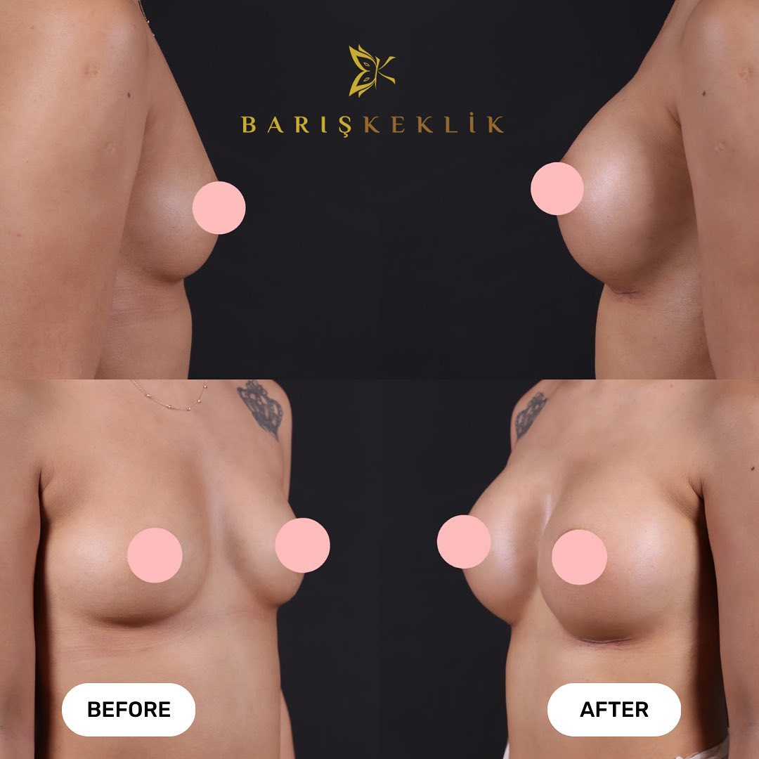 before-after