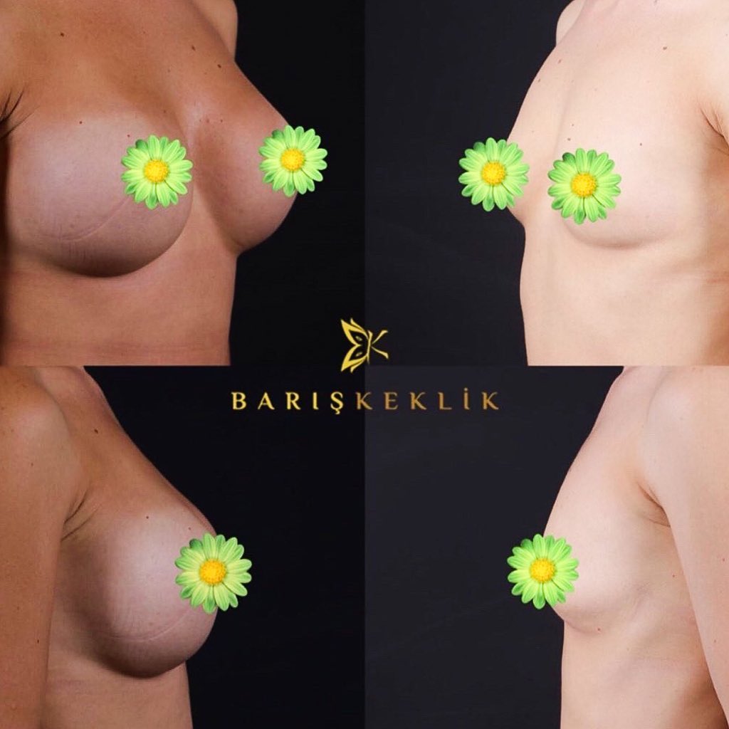 before-after