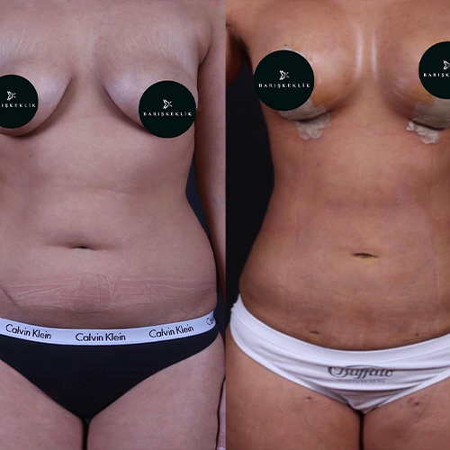 before-after